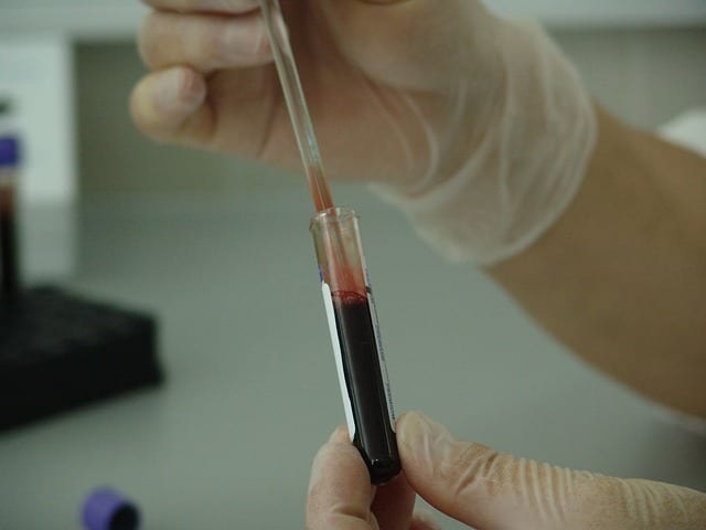 test sanguin alzheimer